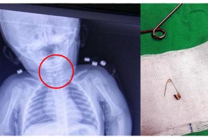 Bebeğin yemek borusuna kaçan çengelli iğne, operasyonla çıkarıldı