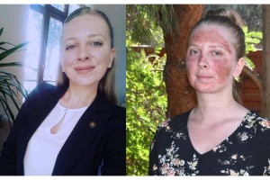 Cilt bakımı yaptıran Müge'nin yüzünde 2'nci derece yanık oluştu