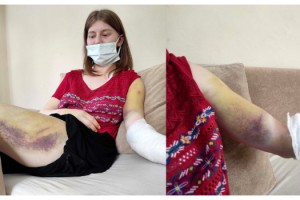 Erkek arkadaşı tarafından beyzbol sopasıyla dövülen kadın yaşadıklarını anlattı