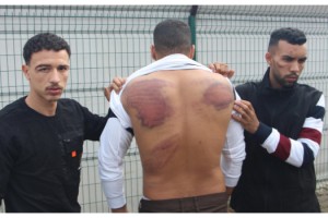 Yunan güvenlik güçlerinin darbettiği Faslı göçmen: Dövdüler, işkence ettiler